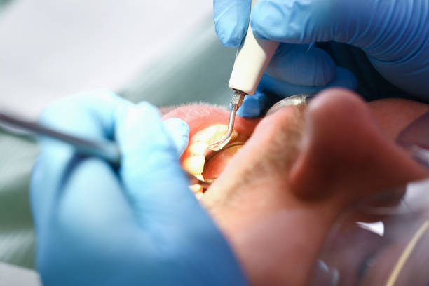 Best Emergency Wisdom Tooth Extraction in Linganore, MD
